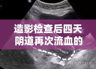 造影檢查后陰道出血，原因解析與醫(yī)學指導