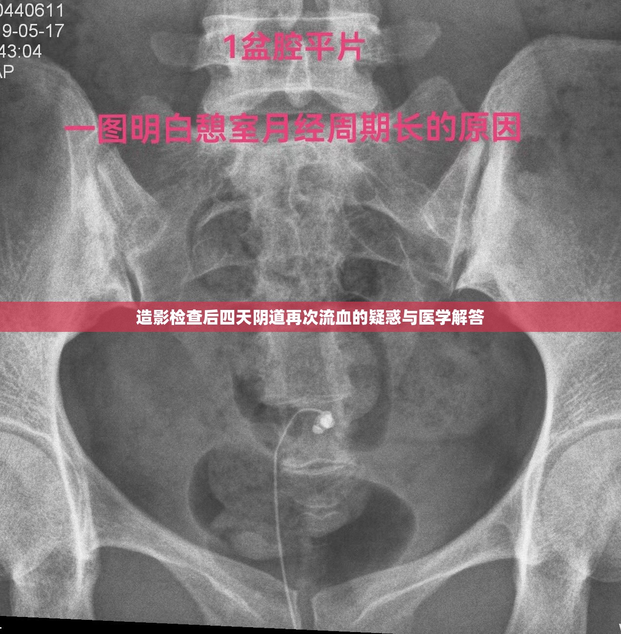 造影檢查后陰道出血，原因解析與醫(yī)學指導