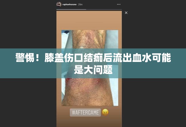 警惕！膝蓋傷口結(jié)痂后流出血水可能是大問(wèn)題