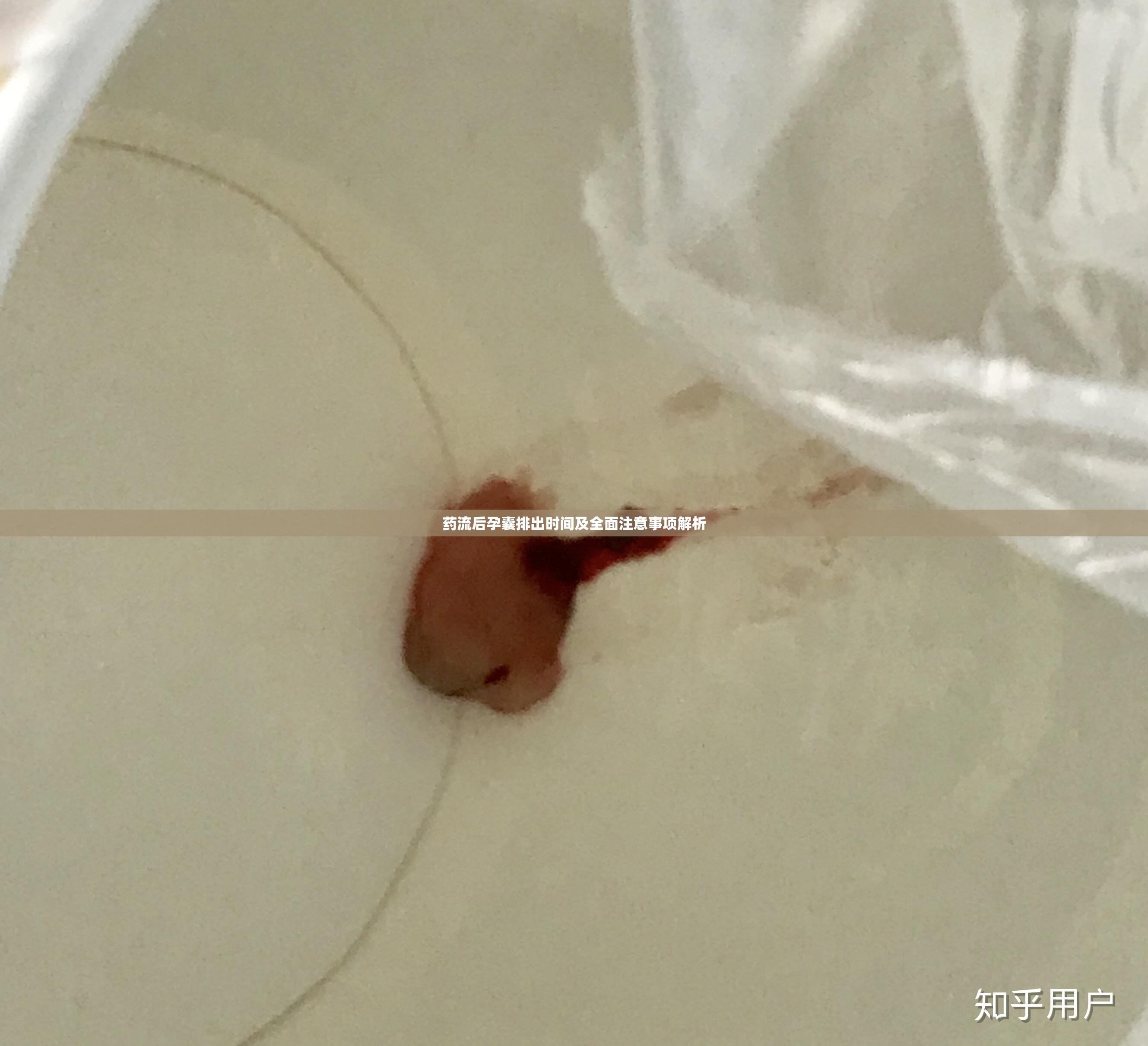 藥流后孕囊排出與注意事項全解析