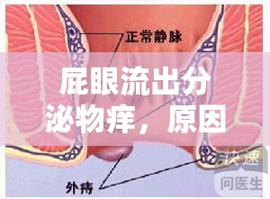 肛門(mén)分泌物異常，原因、癥狀及處理方法