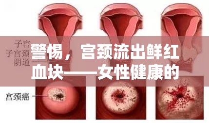 警惕，宮頸流出鮮紅血塊——女性健康的隱形警鐘
