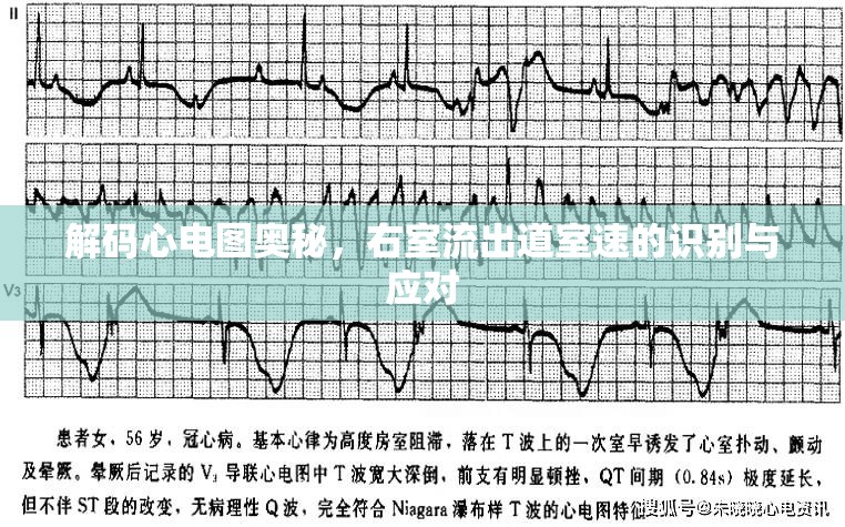 心電圖解讀，識(shí)別與處理右室流出道室速