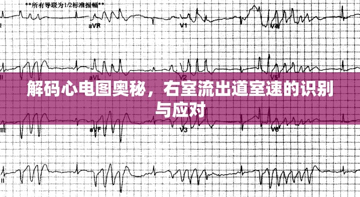 心電圖解讀，識(shí)別與處理右室流出道室速