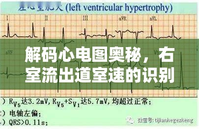 心電圖解讀，識(shí)別與處理右室流出道室速