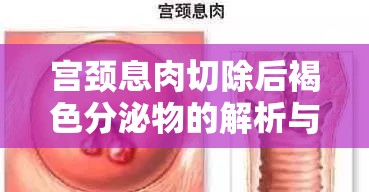 宮頸息肉切除后褐色分泌物的解析與應(yīng)對