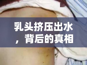 乳頭擠壓出水，背后的真相與應(yīng)對(duì)策略