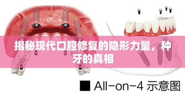 揭秘現(xiàn)代口腔修復(fù)的隱形力量，種牙的真相