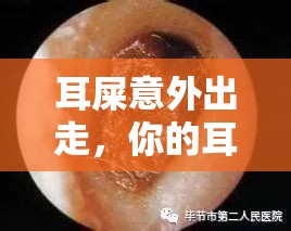 耳屎意外出走，你的耳朵小衛(wèi)士的應(yīng)對指南