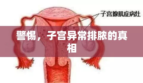 警惕，子宮異常排膿的真相