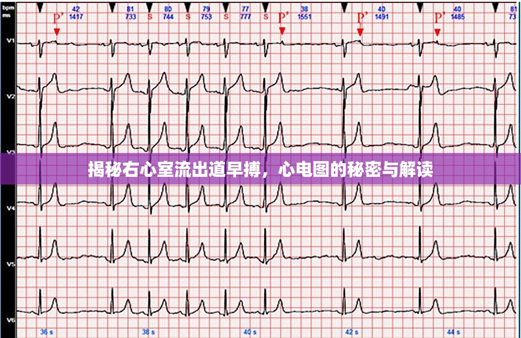 揭秘右心室流出道早搏，心電圖的秘密與解讀