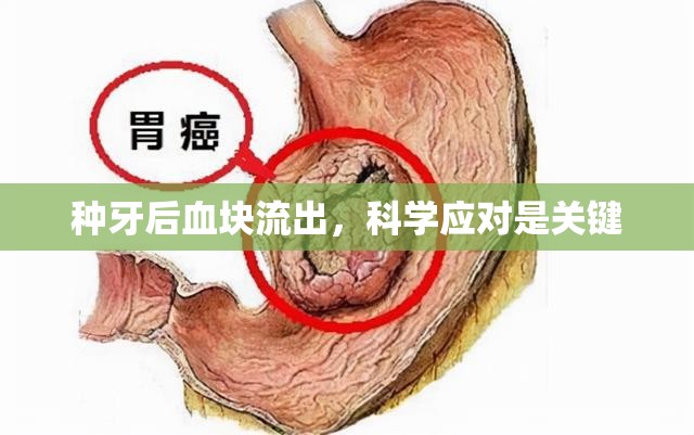 種牙后血塊流出，科學(xué)應(yīng)對是關(guān)鍵