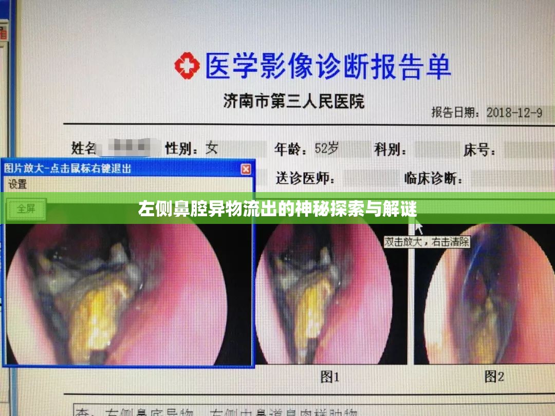 左側(cè)鼻腔異物流出的神秘探索與解謎