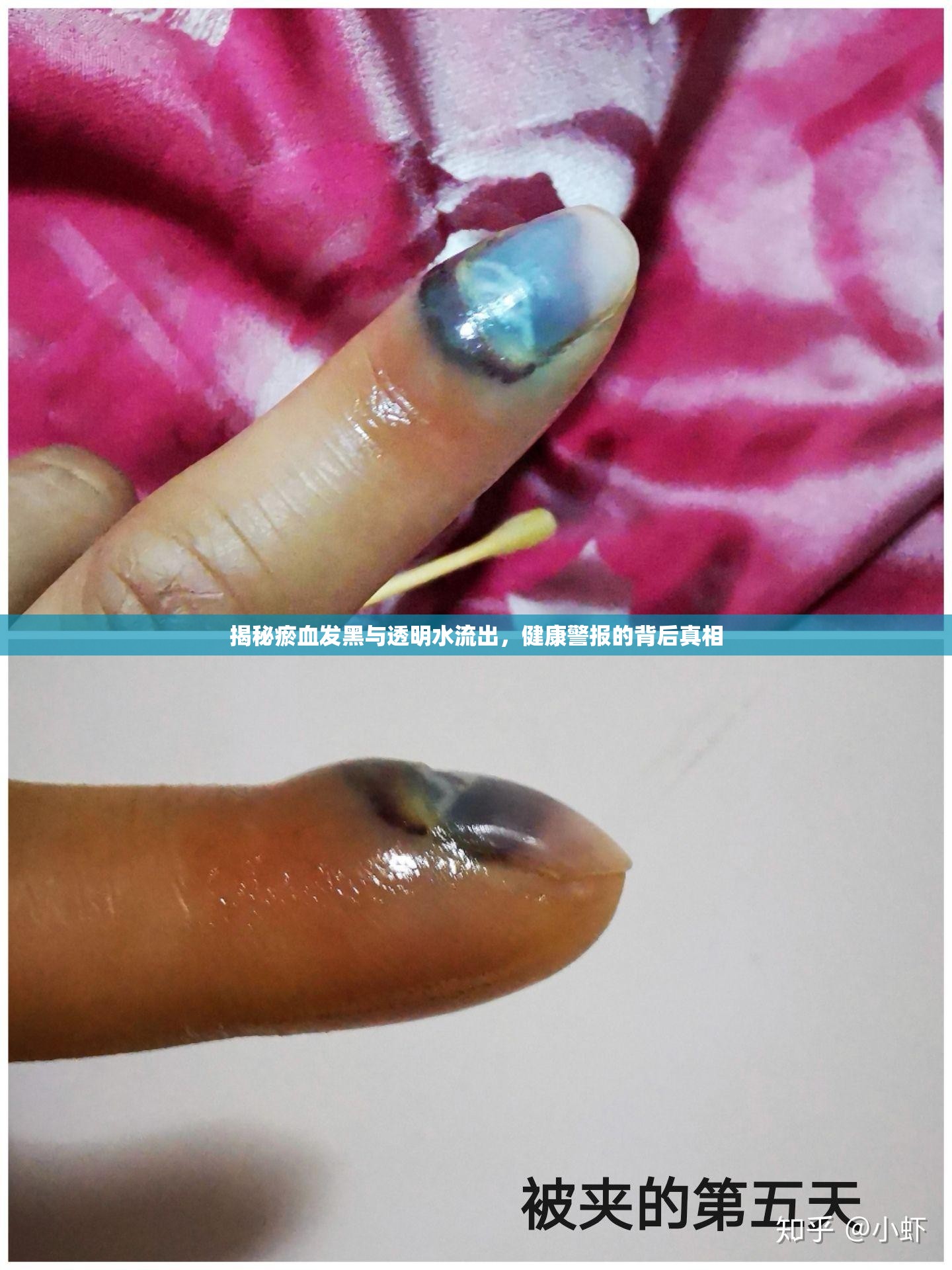 揭秘瘀血發(fā)黑與透明水流出，健康警報的背后真相