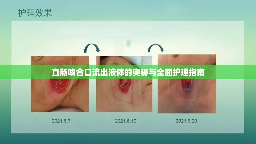 直腸吻合口流出液體的奧秘與全面護理指南