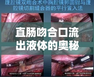 直腸吻合口流出液體的奧秘與全面護理指南