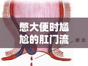 憋大便時尷尬的肛門流水現(xiàn)象，健康警報與原因揭秘