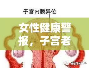女性健康警報，子宮老感覺有血絲流出的應(yīng)對策略