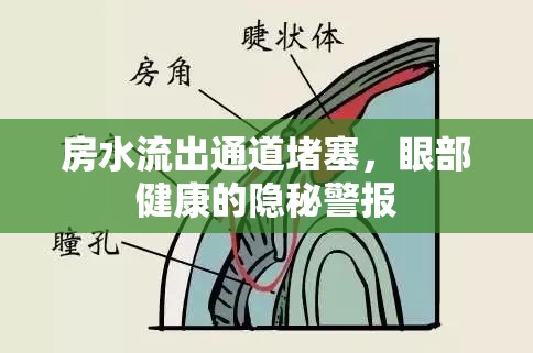 房水流出通道堵塞，眼部健康的隱秘警報(bào)
