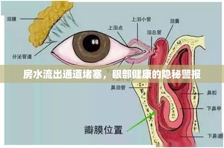 房水流出通道堵塞，眼部健康的隱秘警報(bào)