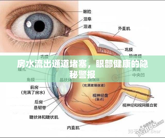 房水流出通道堵塞，眼部健康的隱秘警報(bào)