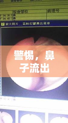 警惕，鼻子流出黃色液體可能是潛在健康信號