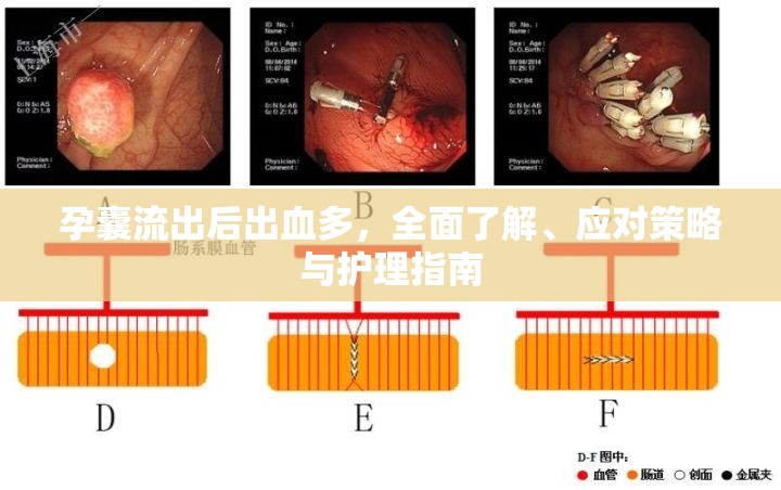 孕囊流出后出血多，全面了解、應(yīng)對策略與護(hù)理指南