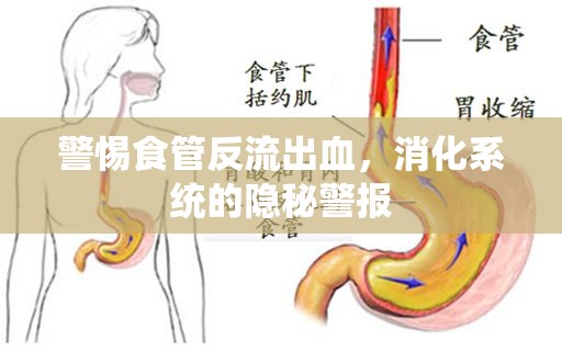 警惕食管反流出血，消化系統(tǒng)的隱秘警報