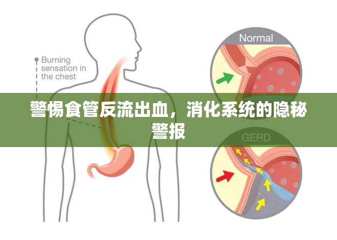 警惕食管反流出血，消化系統(tǒng)的隱秘警報
