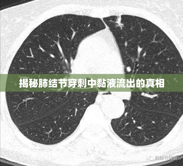 揭秘肺結(jié)節(jié)穿刺中黏液流出的真相