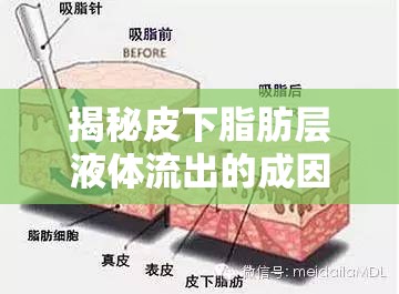 揭秘皮下脂肪層液體流出的成因與應(yīng)對(duì)策略