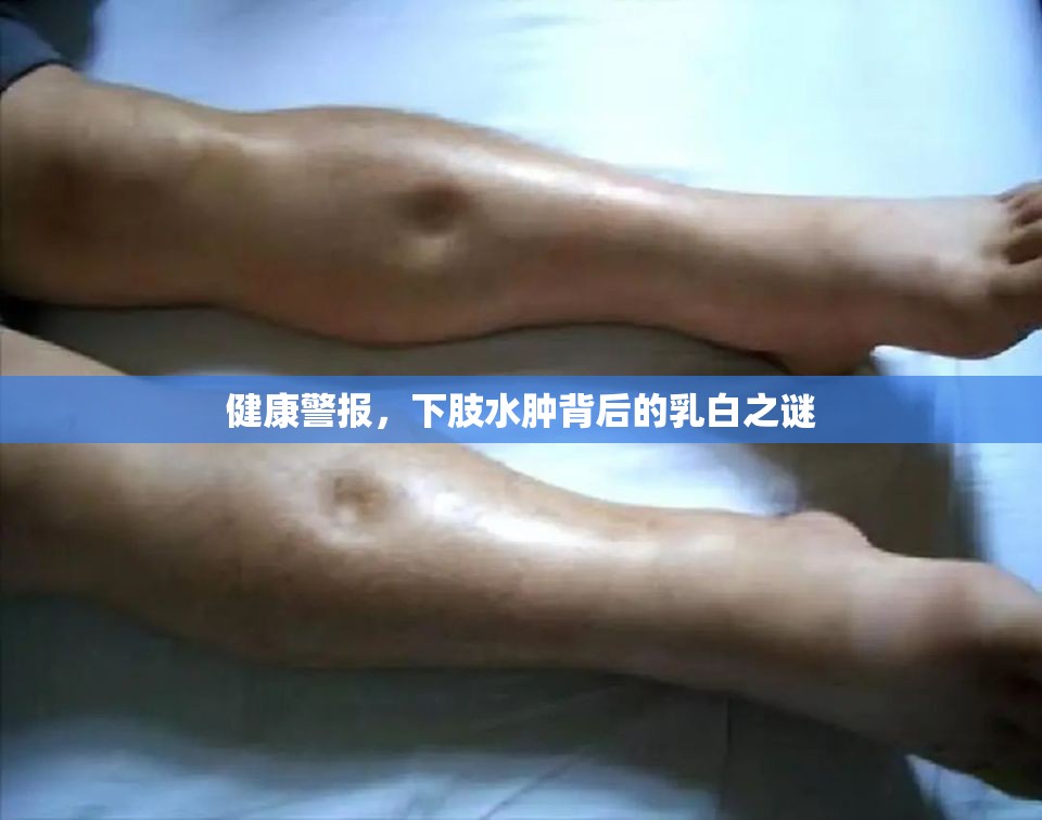 健康警報，下肢水腫背后的乳白之謎