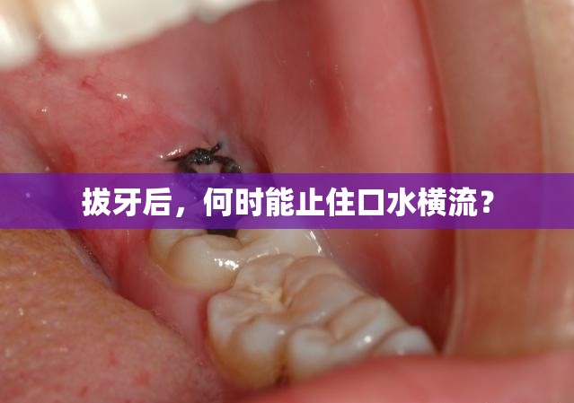 拔牙后，何時能止住口水橫流？
