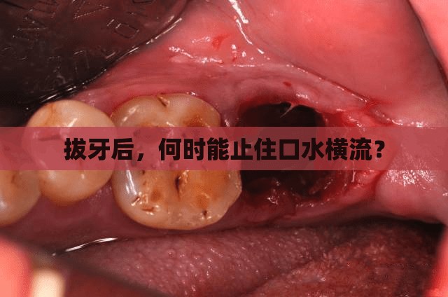 拔牙后，何時能止住口水橫流？