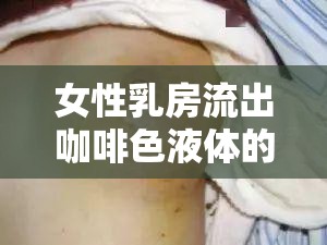女性乳房流出咖啡色液體的可能原因與健康風險