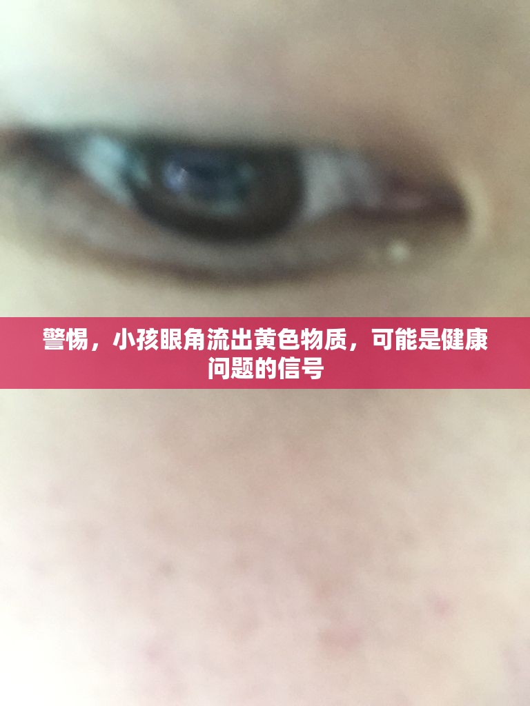 警惕，小孩眼角流出黃色物質(zhì)，可能是健康問題的信號