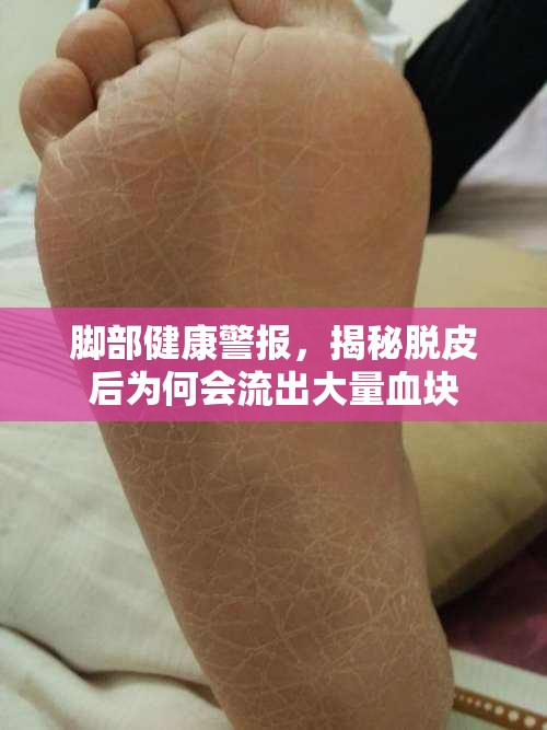 腳部健康警報(bào)，揭秘脫皮后為何會(huì)流出大量血塊