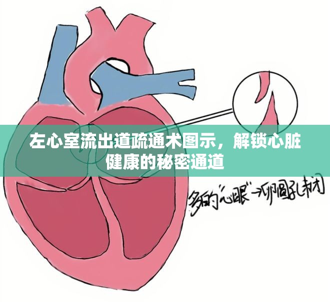 左心室流出道疏通術(shù)圖示，解鎖心臟健康的秘密通道