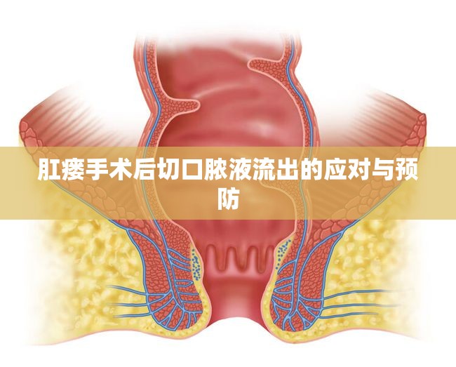 肛瘺手術(shù)后切口膿液流出的應(yīng)對與預(yù)防