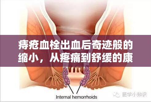 痔瘡血栓出血后奇跡般的縮小，從疼痛到舒緩的康復(fù)之旅