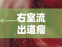 右室流出道瘤，一種罕見的心臟疾病及其特點(diǎn)