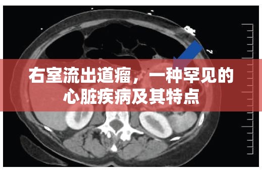 右室流出道瘤，一種罕見的心臟疾病及其特點(diǎn)