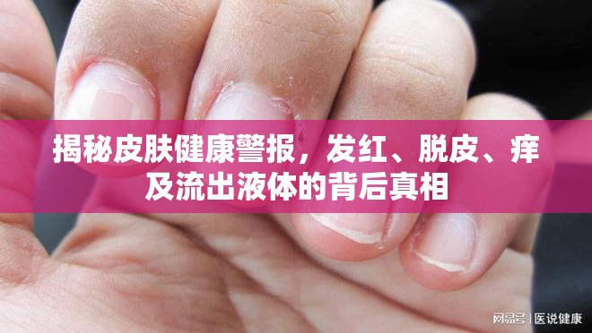 揭秘皮膚健康警報(bào)，發(fā)紅、脫皮、癢及流出液體的背后真相