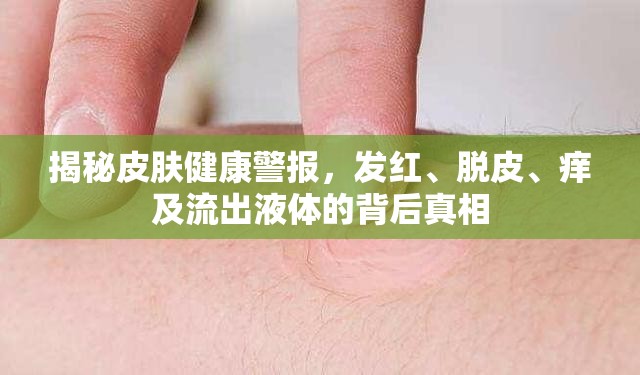揭秘皮膚健康警報(bào)，發(fā)紅、脫皮、癢及流出液體的背后真相
