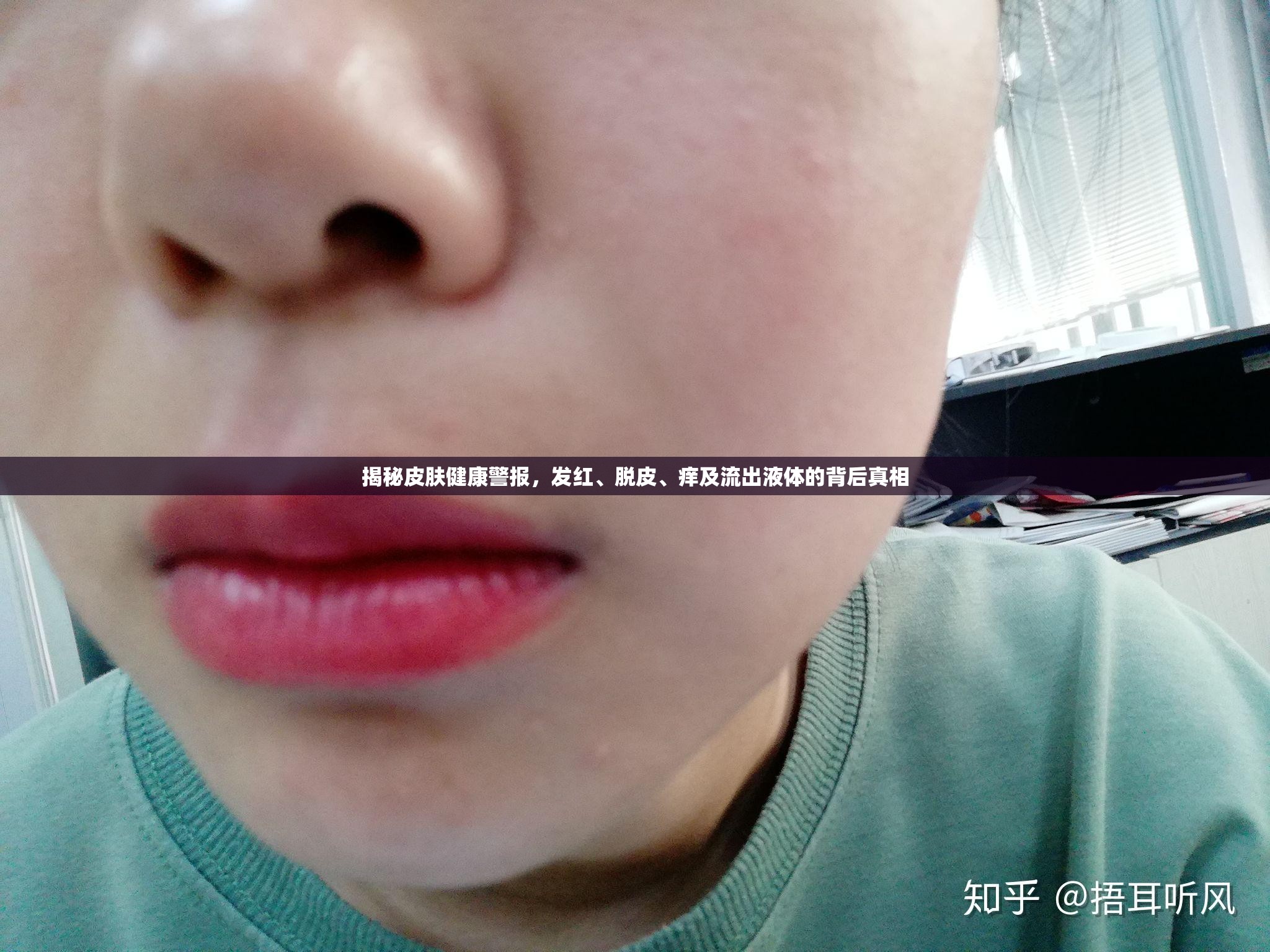 揭秘皮膚健康警報(bào)，發(fā)紅、脫皮、癢及流出液體的背后真相