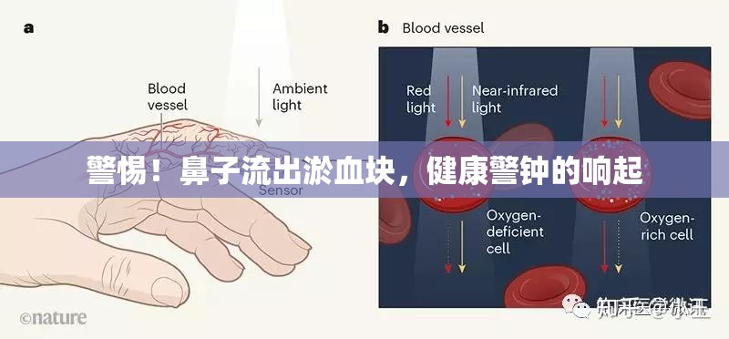 警惕！鼻子流出淤血塊，健康警鐘的響起