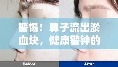 警惕！鼻子流出淤血塊，健康警鐘的響起