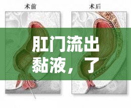 肛門流出黏液，了解癥狀、原因與應(yīng)對(duì)策略