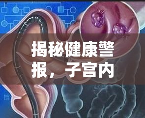 揭秘健康警報(bào)，子宮內(nèi)肉瘤的真相與應(yīng)對(duì)策略