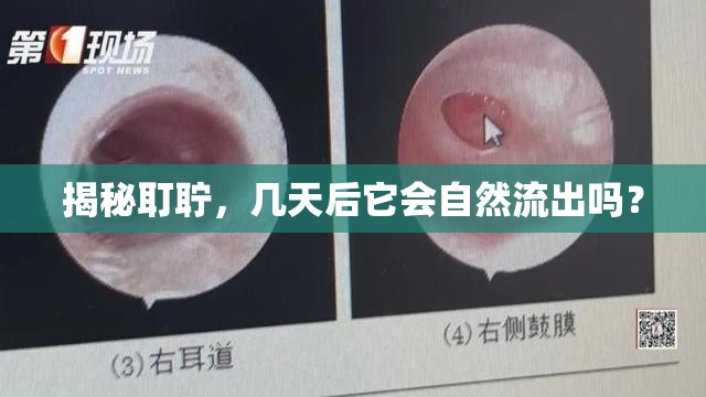 揭秘耵聹，幾天后它會(huì)自然流出嗎？